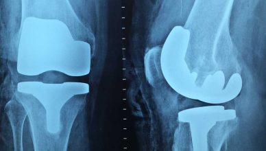 trattamento per l’osteoporosi