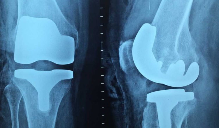 trattamento per l’osteoporosi